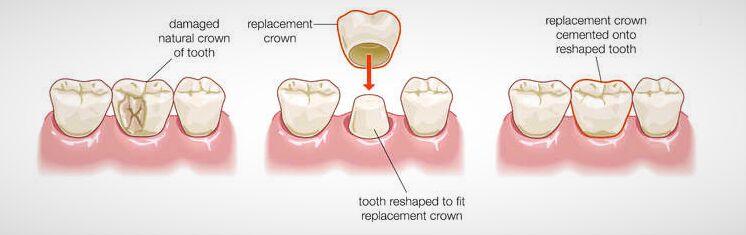 Dental Crowns Surgery Singapore