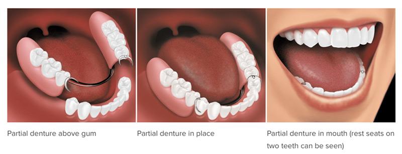 What are Removable Dentures ile ilgili görsel sonucu