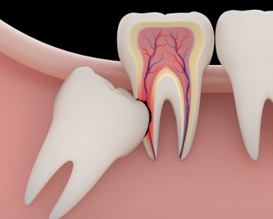 Tooth-Extractions3