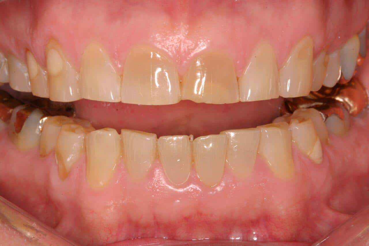 Bruxism Treatment Grinding of Teeth In Sleep