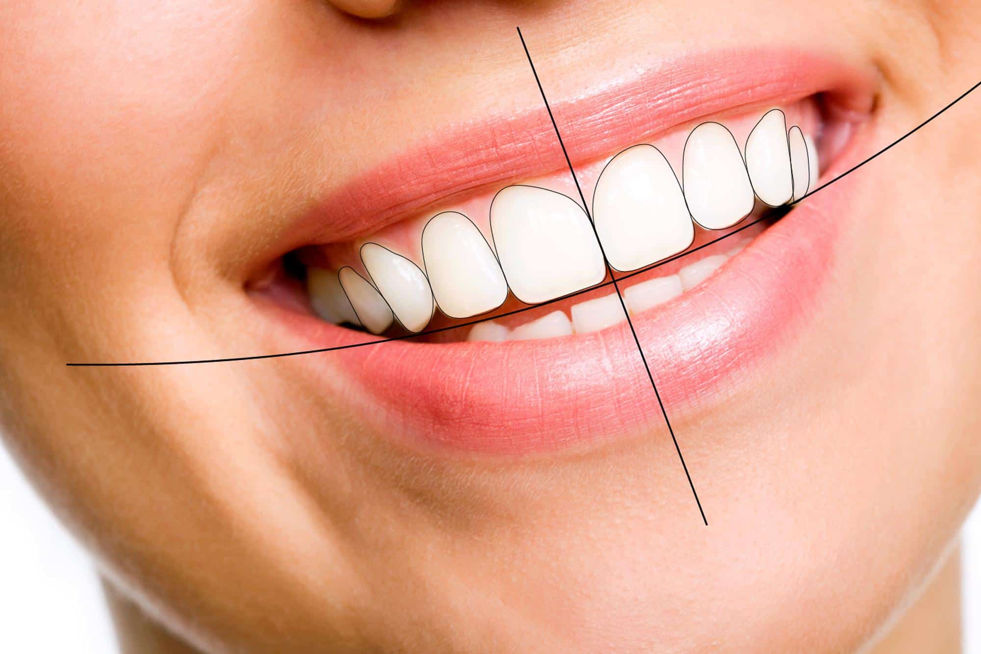 Smile Makeover Digital Smile Design - Elite Dental Group