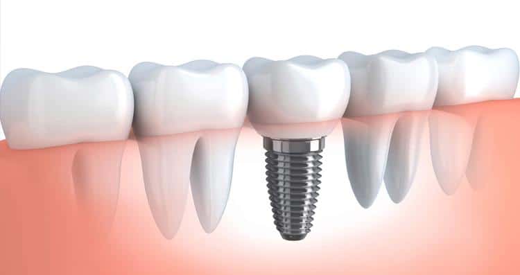 Dental Implants - mini dental implants