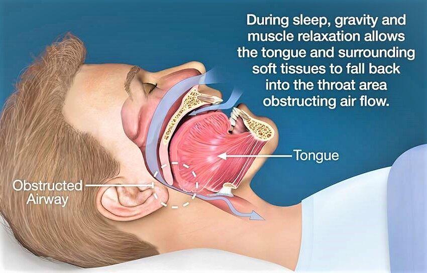 Image result for obstructive sleep apnea