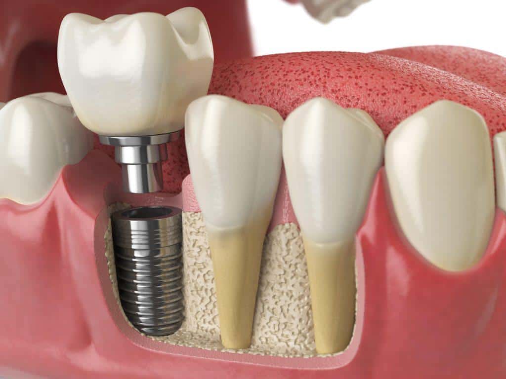 Dental Implants Singapore